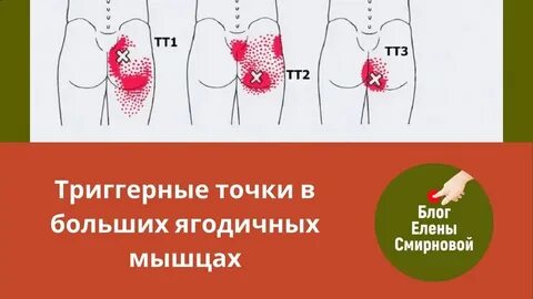 Боль в средней ягодичной