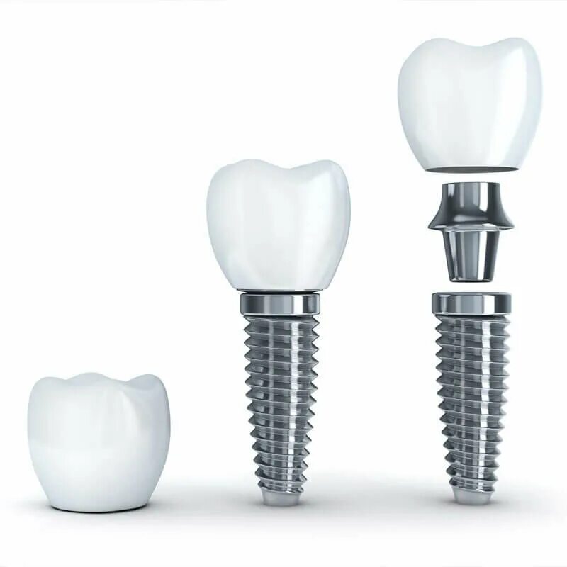 зубной имплант красноярск