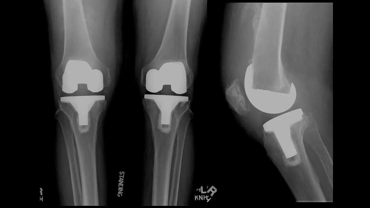 Эндопротезирование коленного сустава рентген. Остеомиелит после эндопротезирования коленного сустава. Нестабильность коленного эндопротеза рентген. Эндопротез коленного сустава рентген. Осложнения после эндопротезирования тазобедренного сустава