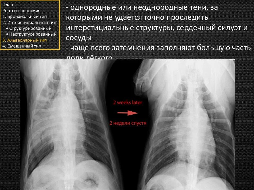 Затемнение верхней доли легкого. Анатомия легких рентген. Ренгентанатомия лёгких. Затемнения бронхиального типа. Затемнения интерстициального типа.