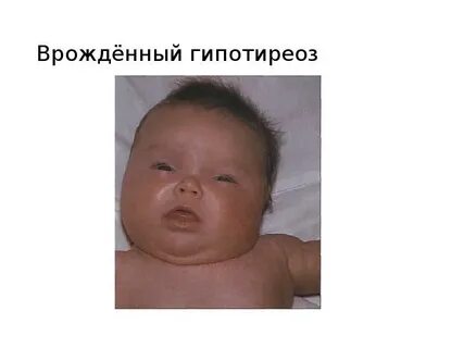 Гипотиреоз у новорожденных симптомы