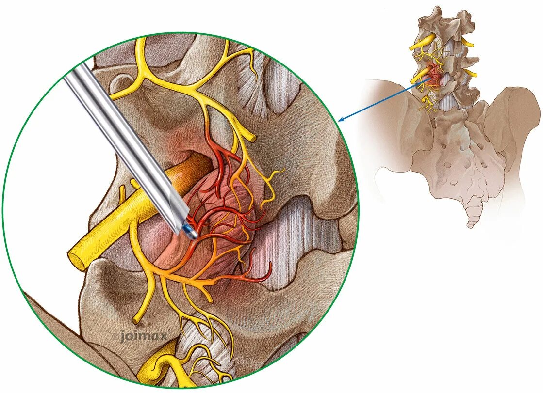 Фасеточная блокада. Блокада фасеточного сустава l5-s1. Фасеточный синдром l5-s1. Фасеточные суставы поясничного отдела позвоночника. Радиочастотная деструкция фасеточных суставов.