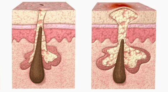 Акне комедоны черные точки. Камедон угорь подкожный. Пор алы