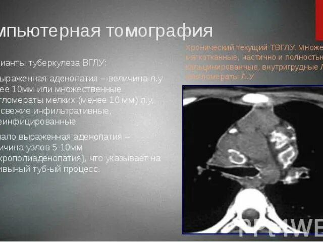 Аденопатия. Туберкулез внутригрудных лимфатических узлов кт. Саркоидоз внутригрудных лимфатических узлов кт. Рентгенодиагностика инфильтративного туберкулеза на кт.