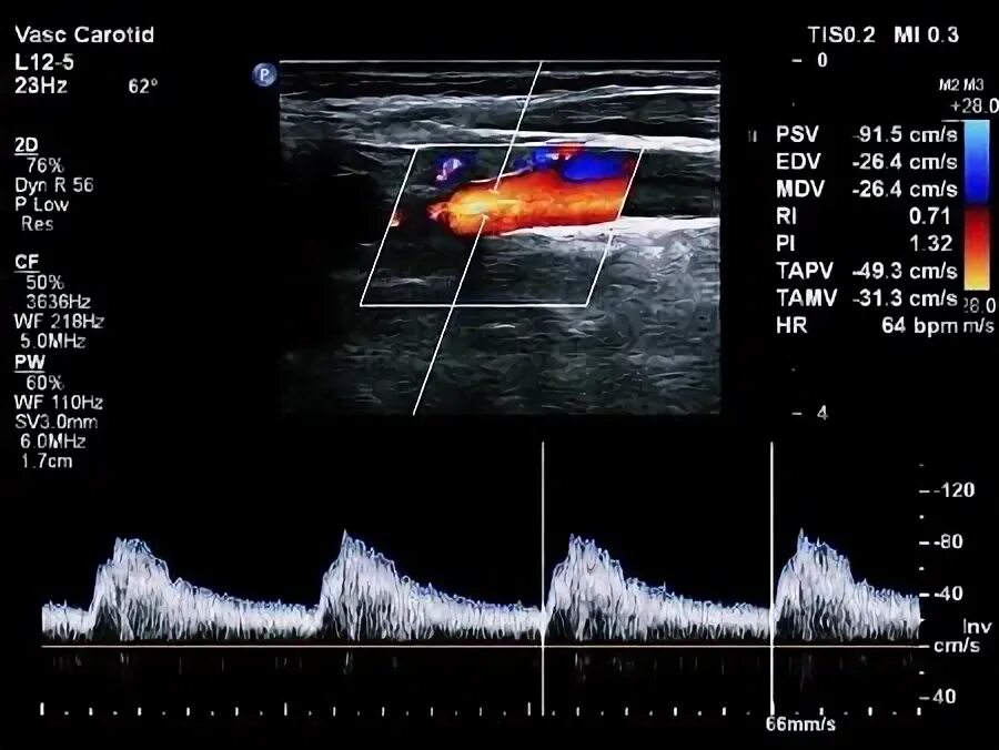 Протокол УЗИ дуплексное сканирование брахиоцефальных артерий. Триплексное сканирование сосудов головного мозга норма. Ультразвуковая триплексное сканирование бца. Ультразвуковая допплерография экстракраниальных сосудов.