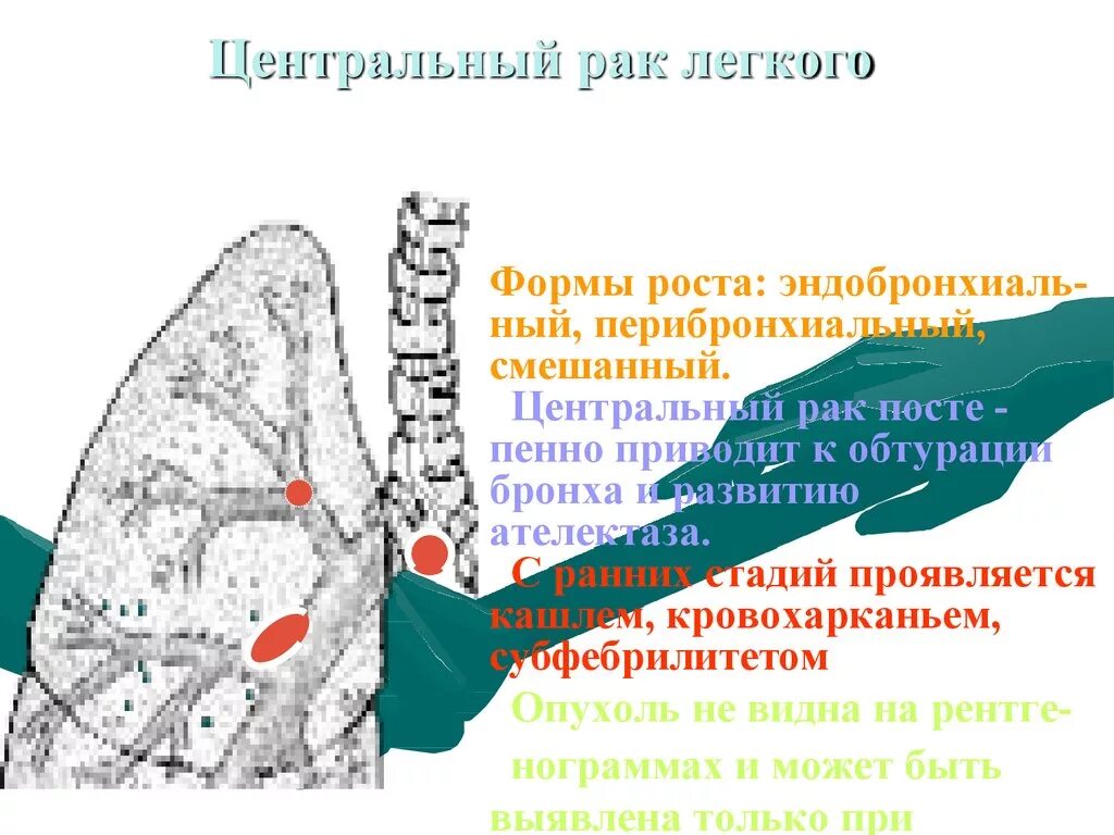 Центральный рак правого. Уентральныйрак легкого. Центральная карцинома легкого. Центральный CA левого легкого. Центральное CR левого легкого.