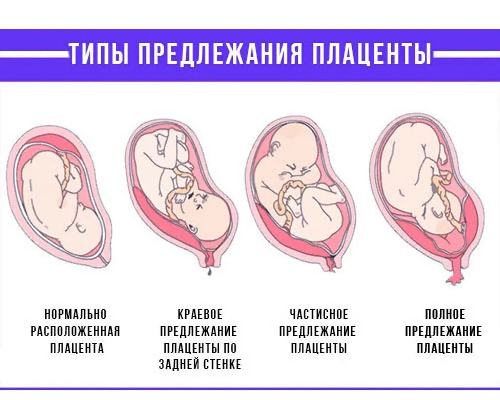 Диагноз предлежание. Краевое предлежание плаценты. Краев предлежание плаценты. Краевое предлежание последа. Краевое предлежание плаценты у внутреннего зева.