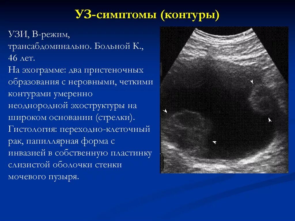 Умеренно диффузно неоднородная. Лейкоплакия мочевого пузыря на УЗИ. Объемное образование мочевого пузыря на УЗИ. Опухоль мочевого пузыря УЗИ. УЗИ мочевого пузыря на УЗИ.