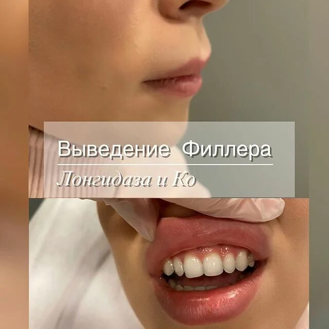 Препараты для выведения филлера. Губы до и после лонгидазы. Био гель филлер. Коррекция губ после лонгидазы. Эффект тиндаля носослезная.