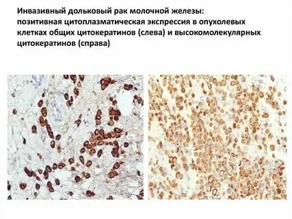 Инвазивная карцинома неспецифического типа что значит