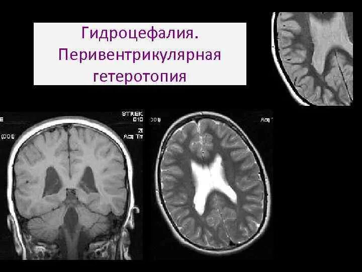 Аномалии головного мозга. Субэпендимальная гетеротопия мрт. Субэпендимарная гетеротопия мрт. Гетеротопия головного мозга мрт. Перивентрикулярная гетеротопия мрт.