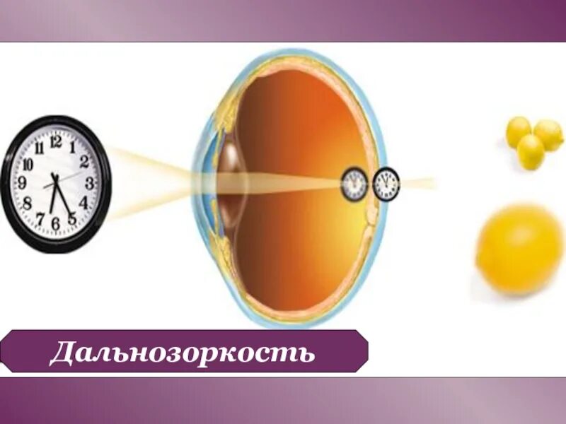 Изображение дальнозоркости