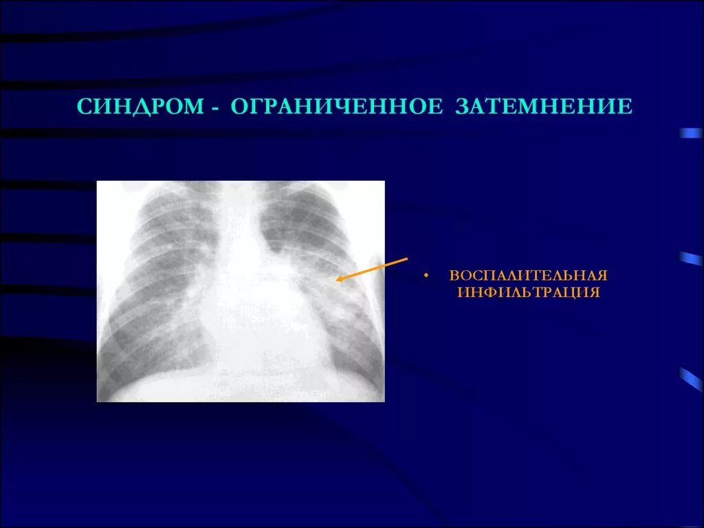 Округлое затемнение. Синдром ограниченного затемнения легочной ткани. Обширное затемнение легочного поля. Синдром затемнения инфильтрации.