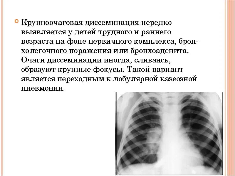 Бронхоаденит это. Казеозный бронхоаденит. инфильтративный бронхоаденит. бронхоаденит у детей на рентгене.