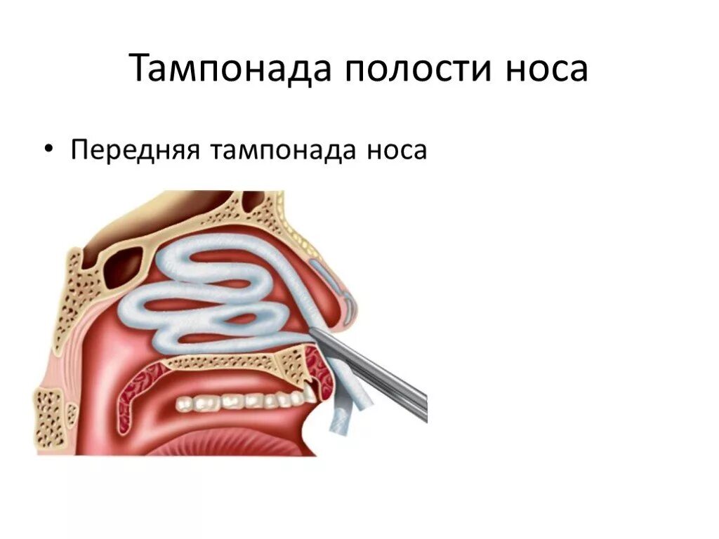 Передняя томпонация полости носа. Передняя тампонада носовой полости. Передняятомпонада носа. Передняя и задняя тампонада полости носа.