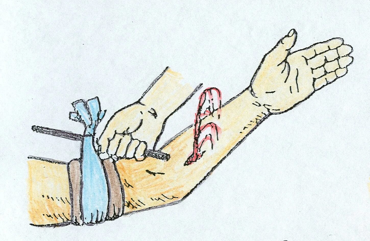 Основные правила оказания первой помощи при переломах конечностей. Открытый перелом предплечь. Жжет при переломе. Жжет при переломе. Техника наложения кровоостанавливающего жгута на конечность.