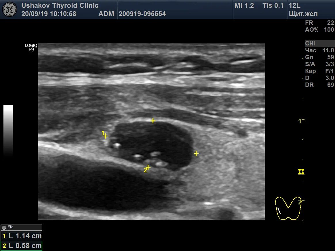 УЗИ ti rads 4б. Ti-rads 5 УЗИ. УЗИ ti rads 2. Узел по УЗИ ti rads 2.