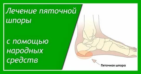 Лечение шпор на ногах народными средствами