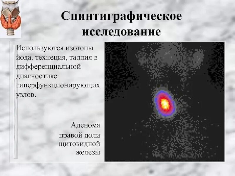 Изотопы щитовидной железы. Гиперфункционирующая аденома щитовидной железы. Сцинтиграфическое изображение щитовидной железы соответствует. Аденома щитовидной железы презентация. Изотоп железа 56