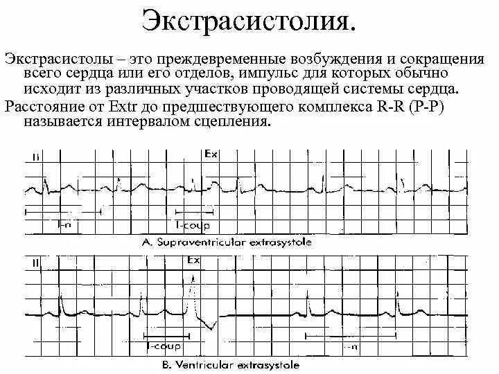 Характеристика пульса при экстрасистолии. Экстрасистолия нарушение проводимости. Экстрасистолия пульс. Монотопные экстрасистолы. Экстрасистолы у женщин