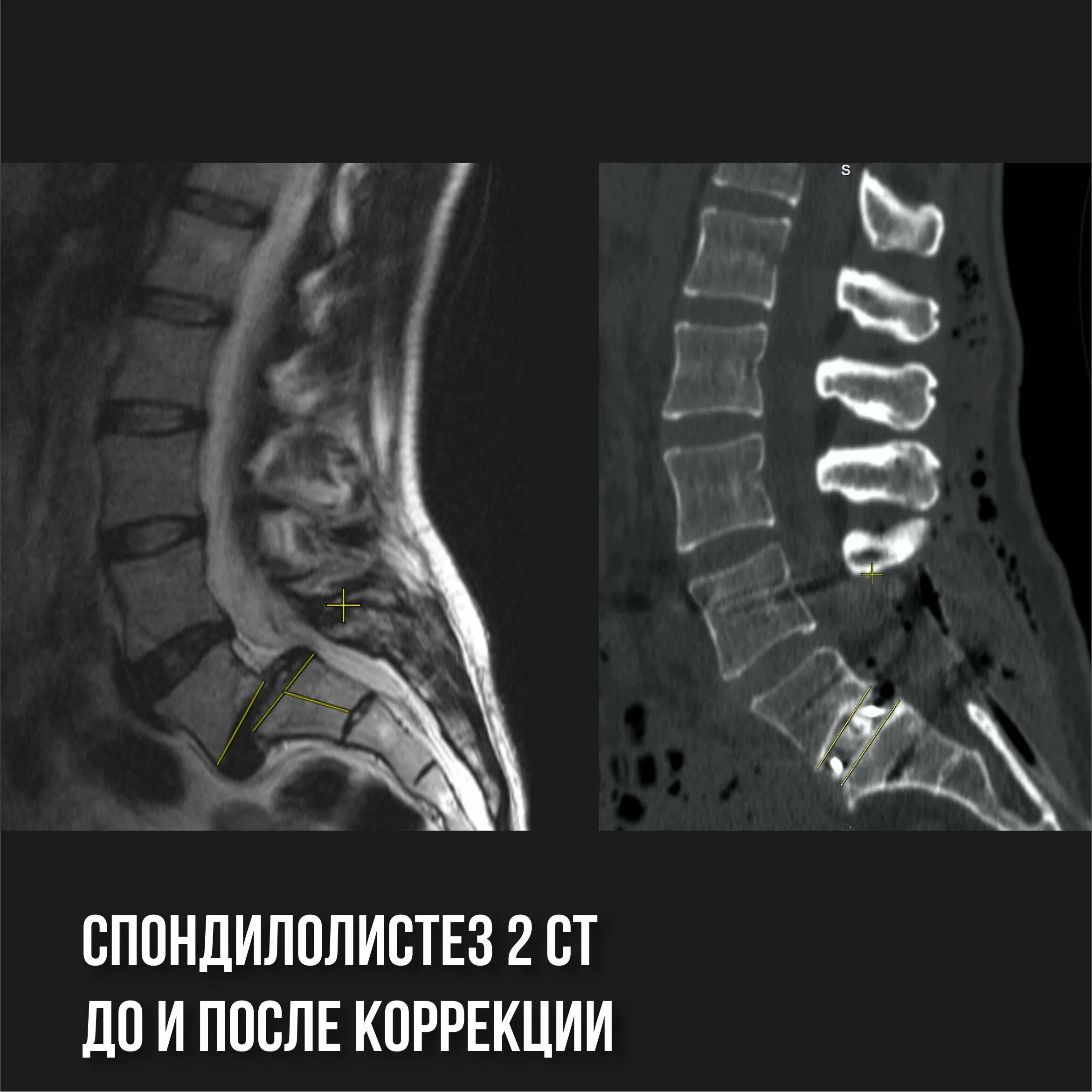 Смещение позвонка поясничного отдела позвоночника. Спондилолистез l2 l3 позвонка. спондилолистез – смещение позвонков. смещение позвонка l5 кпереди. спондилолистез l4 позвонка рентген.