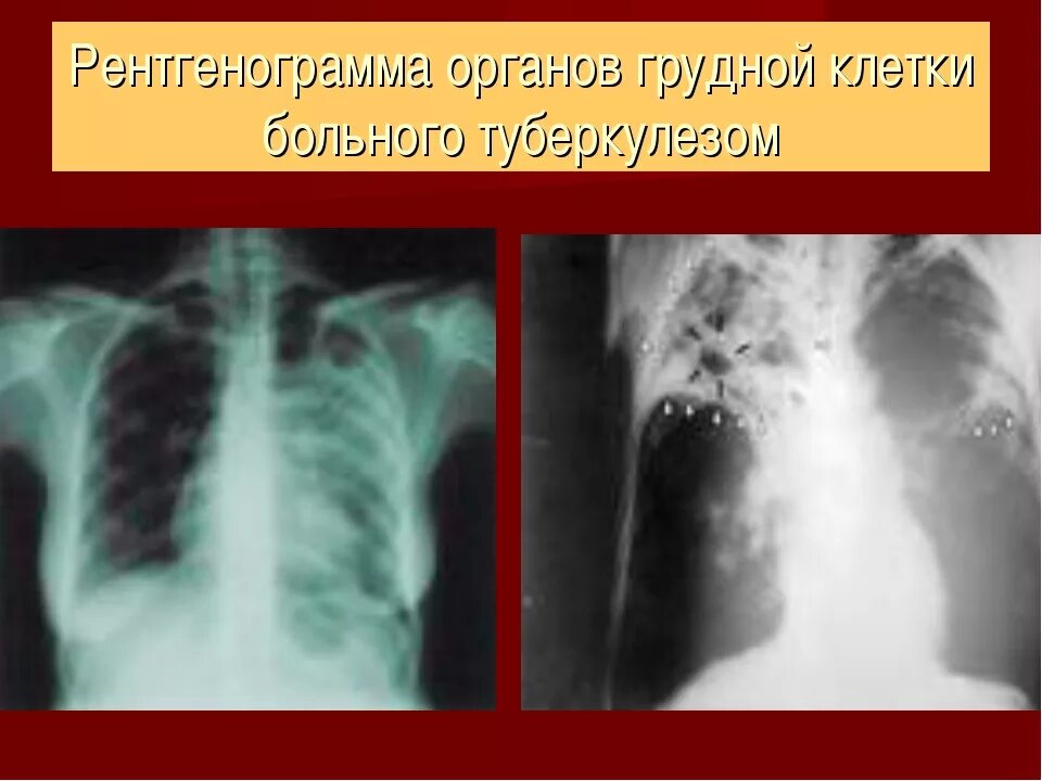 Туберкулез легкого рентгенограмма. Рентген грудной клетки туберкулез. Рентген туберкуkjvf. Туберкулез рентген снимки.