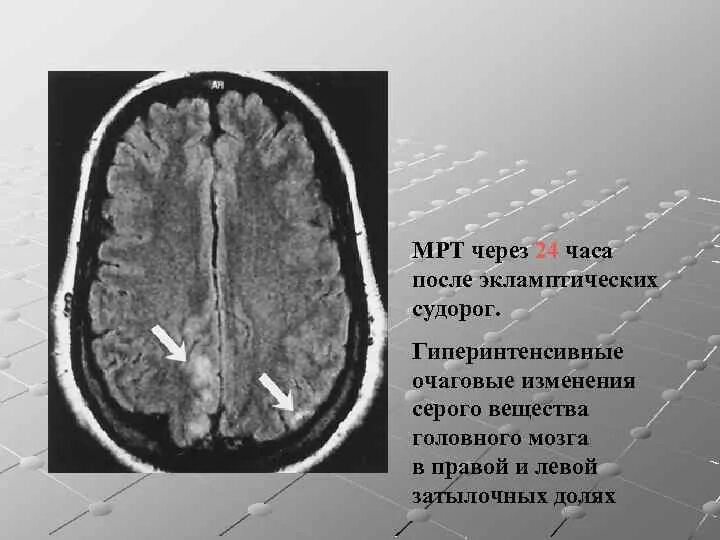Вазогенные очаги белого вещества что это. Периваскулярный отек головного мозга. Вазогенные очаги белого вещества что это. Вазогенные очаги белого вещества что это. Очаг глиоза головного мозга на мрт.