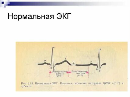 Нормальная экг тест