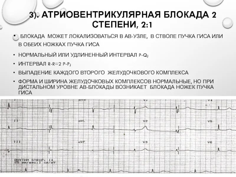 Блокада узла. ЭКГ АВ блокада 1. АВ блокада 2 ст на ЭКГ. АВ блокада 1 степени Холтер. Признаки АВ блокады 2 степени на ЭКГ.