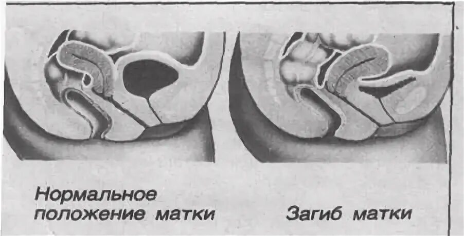 Матка наклонена кзади. Расположение шейки матки кзади. Перегиб матки anteflexio. Беременность при загибе матки кзади. Забеременеть при загибе