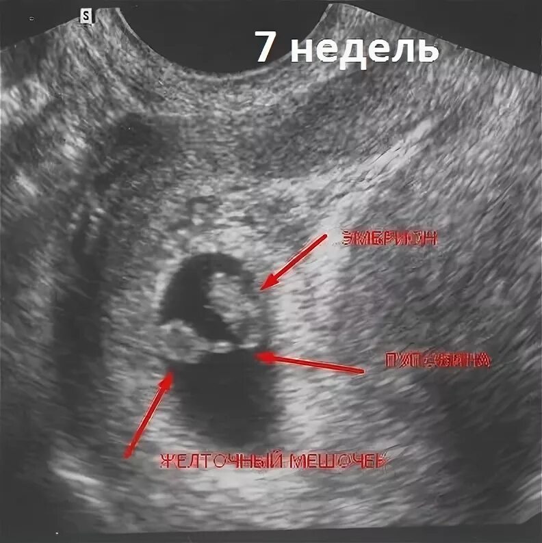 В течении 7 недель 8. 7 Недель беременности фото плода на УЗИ. УЗИ на 7 акушерской неделе беременности. Эмбрион на 7 неделе беременности УЗИ. УЗИ на 7-8 акушерской неделе беременности.