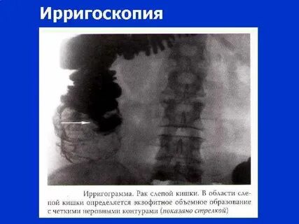 Ирригоскопия отзывы