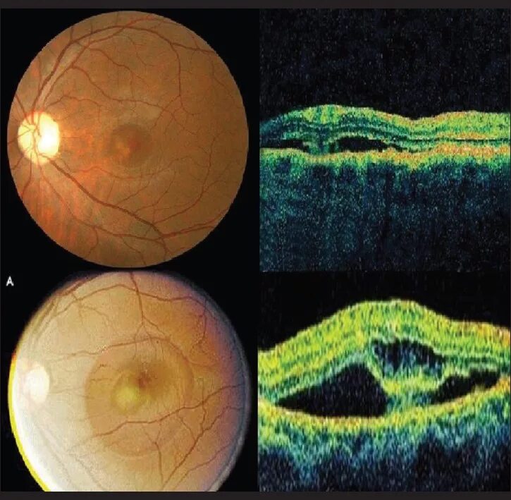 Центральная серозная ретинопатия. Центральный серозный хориоретинит. Центральная серозная хориоретинопатия. Центральная хориоретинопатия сетчатки. Жидкость в сетчатке
