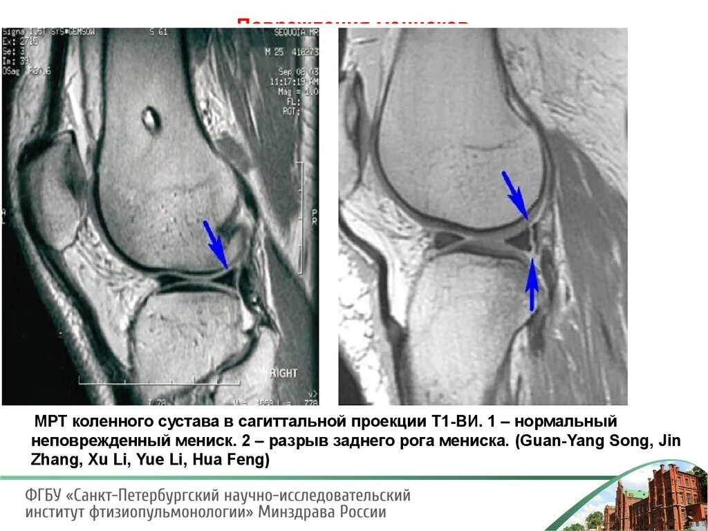 Разрыв мениска коленного сустава рентген. Разрывы менисков коленного сустава мрт. Сагиттальная проекция мрт коленный сустав. Мрт коленного сустава разрыв мениска. Поврежденный мениск коленного сустава