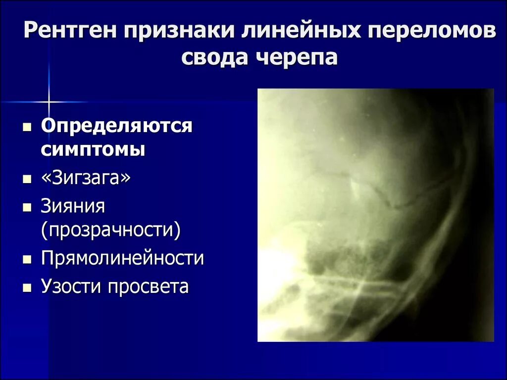 Признаки трещины. Перелом теменной кости черепа рентген. Перелом костей свода черепа рентген. Рентгенодиагностика переломов костей черепа.. Симптомы при переломе свода черепа.