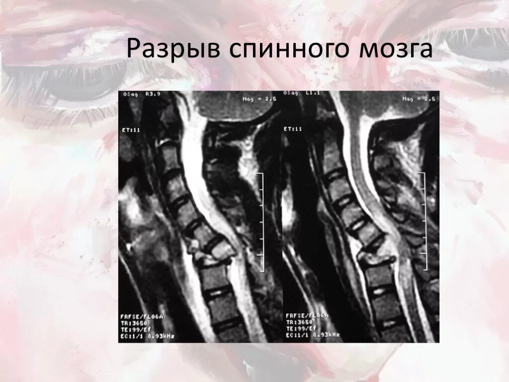 Сотрясение позвоночника. Оазры в спинного мозга. Полный разрыв спинного мозга.