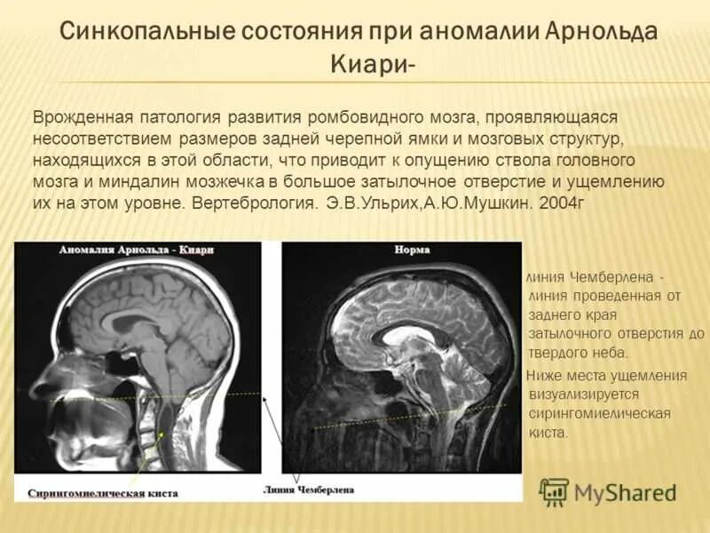 Аномалия киари степени. Мальформация Арнольда-Киари 2 типа. Опущение миндалин мозжечка мрт. Аномалия Арнольда Киари мрт.