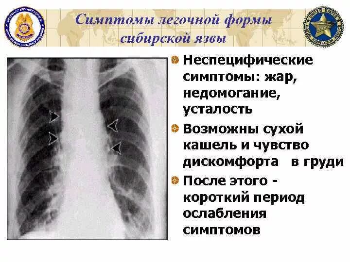 Легочная язва. Легочная форма сибирской язвы. Сибирская язва легочная форма симптомы. Признаки легочной формы сибирской язвы. Кишечная форма сибирской язвы.