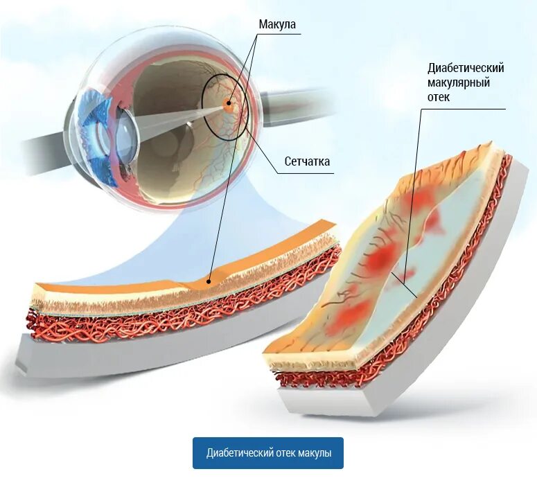 Макулярный отек лечение. Тракционный макулярный отек. Кистовидный макулярный отек сетчатки. Диабетический отек макулы. Диабетический макулярный отек сетчатки.