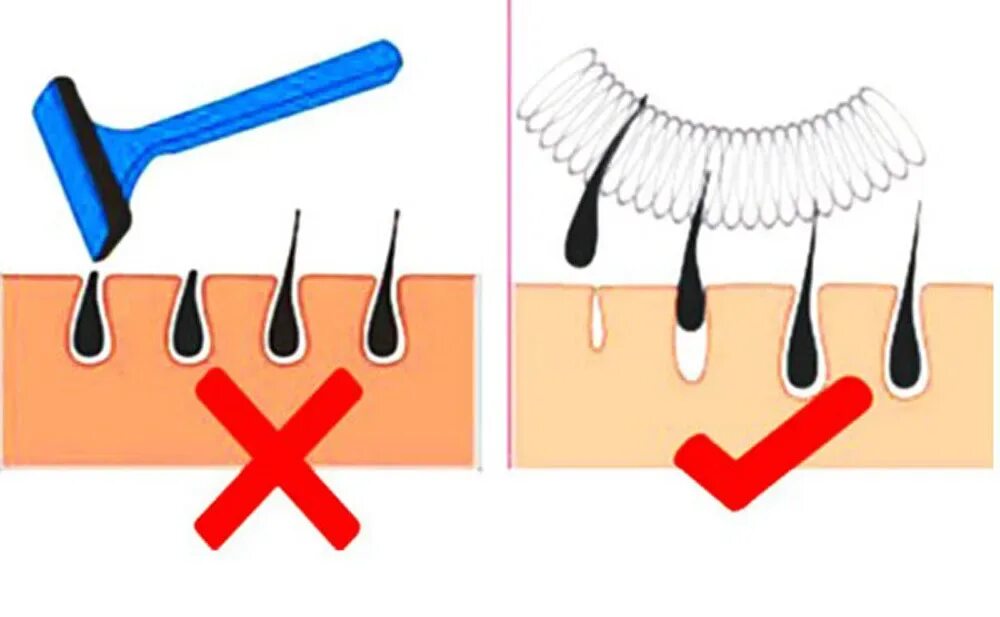 Волосок электроэпиляция. Выдергивание волос пинцетом. Вырывание волос пинцетом. Удаление волос пинцетом. Выщипывание волос пинцетом.
