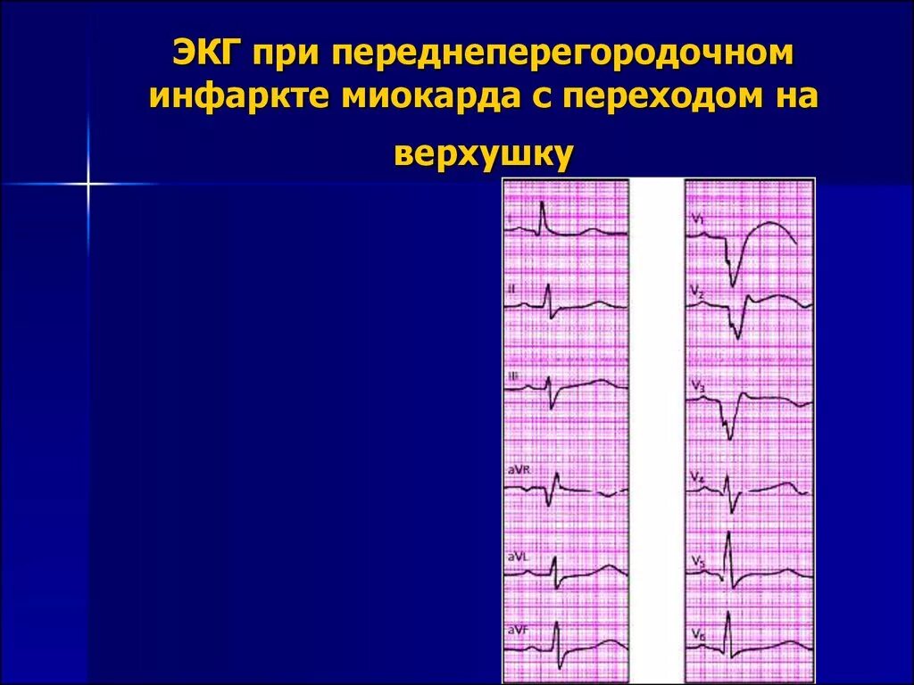 Изменение миокарда передне перегородочной области. Переднеперегородочный инфаркт миокарда на ЭКГ. Передне-перегородочный инфаркт миокарда на ЭКГ. Передне-перегородочный q инфаркт ЭКГ. Инфаркт переднеперегородочной области на ЭКГ.