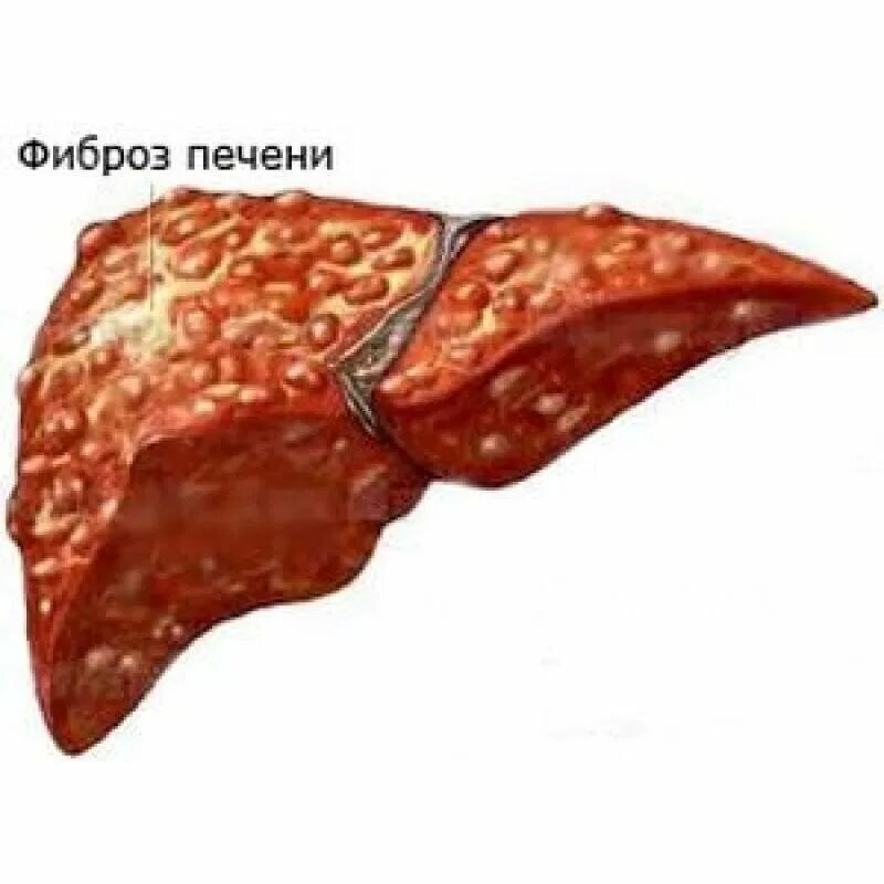 Гепатоз вылечивается