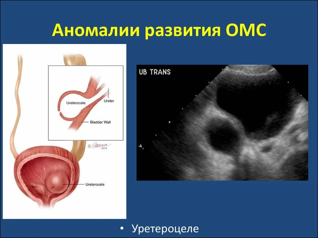 Аномалия мочевого. Уретероцеле мочевого пузыря. Уретероцеле цистоскопия. Уретероцеле на УЗИ.