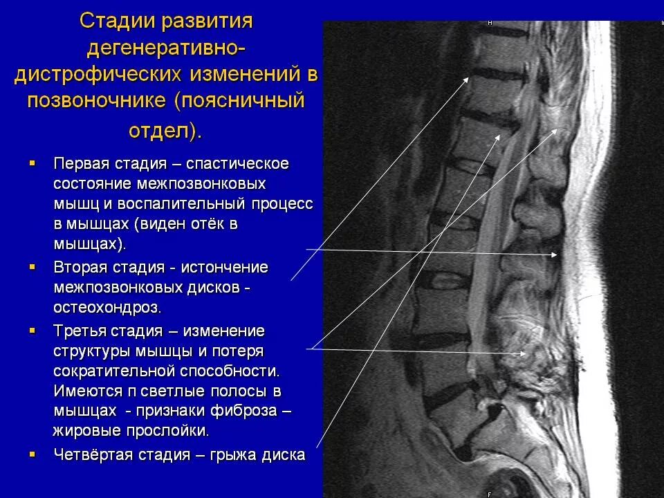 Дистрофические изменения позвоночника. Этапы развития остеохондроза позвоночника. Остеохондроза дисков пояснично-крестцового отдела. Остеохондроз пояснично крестцового отдела 1-2 степени. Дистрофические изменения пояснично-крестцового отдела.