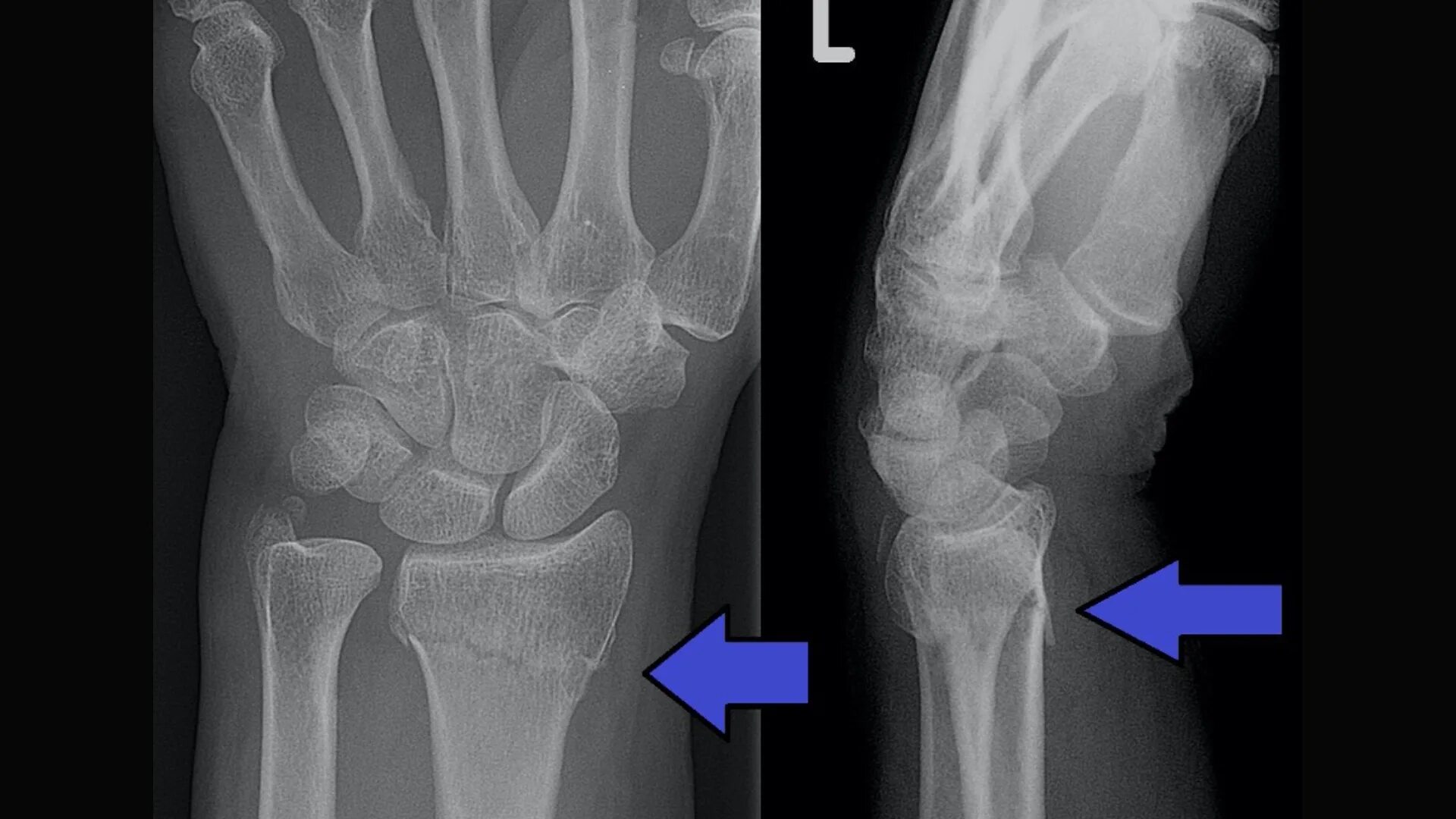 Перелом лучезапястного сустава рентген. Перелом запястья со смещением рентген. Перелом н/3 лучевой кости. Рентген перелома лучевой кости руки.