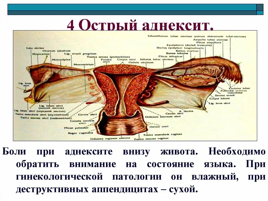 Острый сальпингоофорит. Острый аднексит диагностика. Острый правосторонний сальпингоофорит. Аднексид