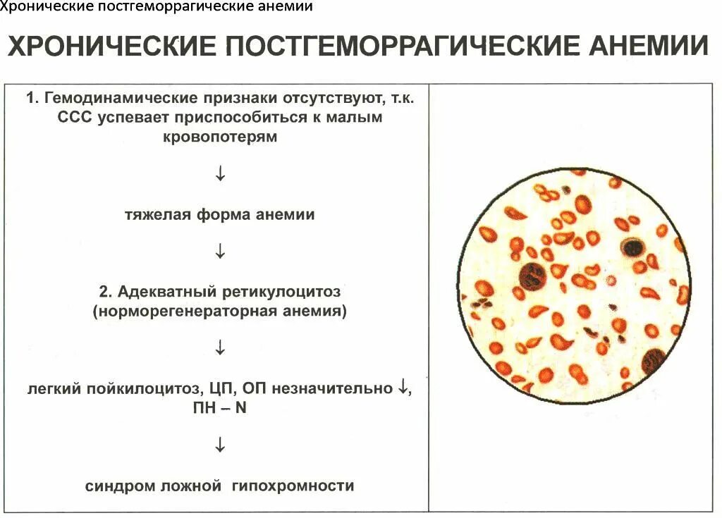 Острая постгеморрагическая анемия показатели крови. Симптомы острой постгеморрагической анемии. Постгеморрагическая анемия клинические проявления. Хроническая постгеморрагическая анемия анализ.