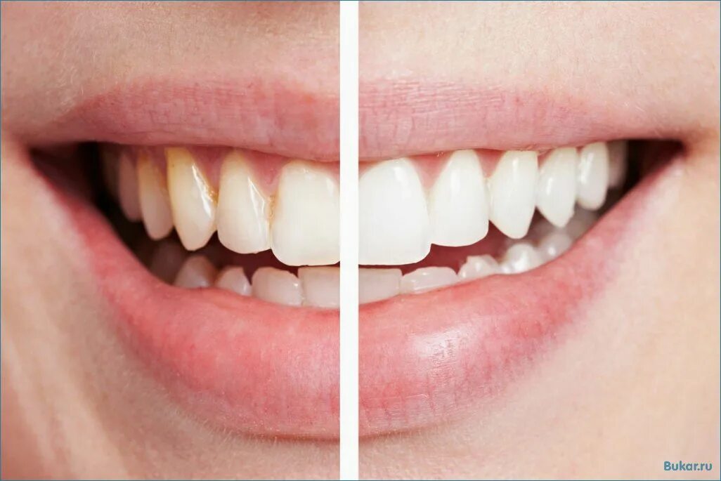 Отбеливание полости рта. Отбеливание зубов. Отбеливание зубов до и после. Зубы до и после отбеливания.