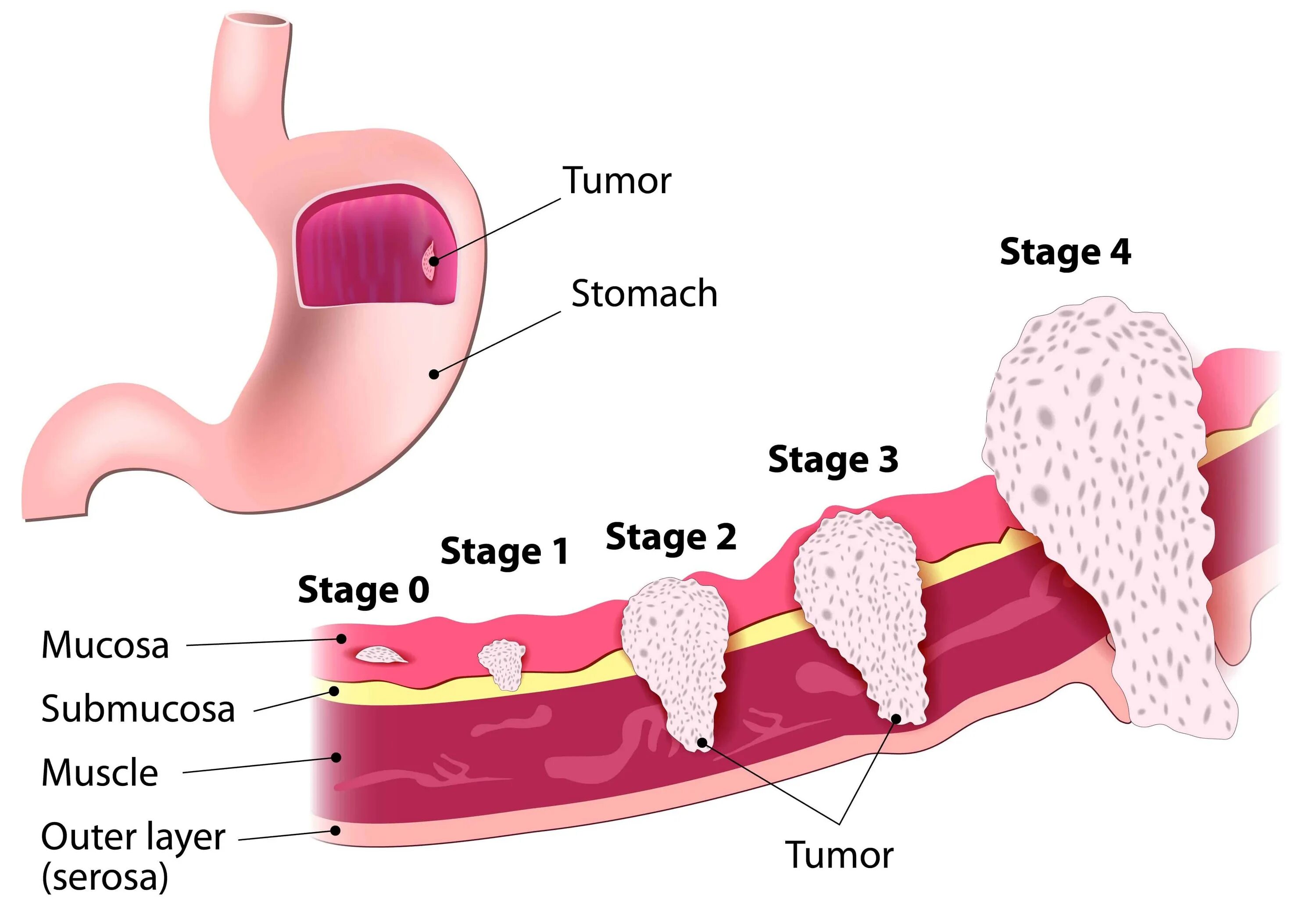 Подслизистый слой пищевода. Стадии развития язвенной болезни желудка. Злокачественная опухоль желудка стадии. Биопсия слизистой желудка. Новообразование на слизистой желудка.