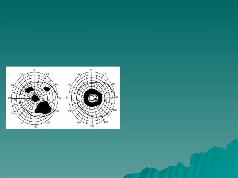 Центральная скотома периметрия. Слепое пятно скотома положительная. Скотома Бьеррума. Центральные скотомы в поле зрения.